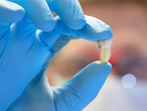 A tooth pulled to avoid the cost of a root canal in Manchester 