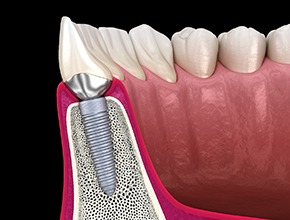 Render of dental implant in Lisle, IL in jaw