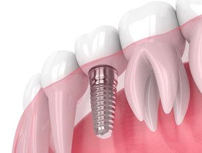 Dental implant having fully integrated with the jaw