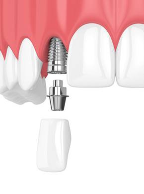 dental implant with abutment and crown replacing missing upper tooth