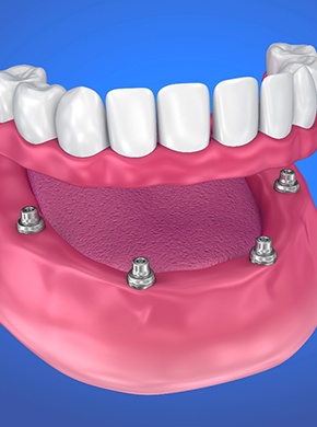 Model of All-On-4 dental implants.
