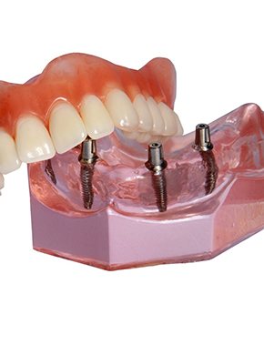 Dental model of implant-supported dentures.